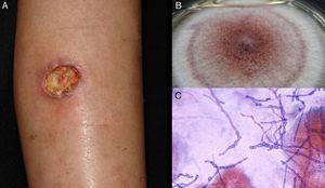 Úlcera de hialofomicose por Acremonium sp. B, Culture (Sabouraud dextrose agar medium). C, Exame directo do exsudado (Giemsa, ampliação original ×40).