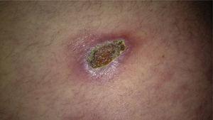Patch with a necrotic central area and erythematous border on the abdomen.