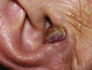 Polypoid lesion of the right ear.