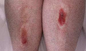 Bilateral atrophic plaques with overlying blisters.