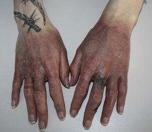 Diffuse pigmentation on the dorsum of the hands after resolution of the lesions. The clear limit at the distal borders of the wrists and the absence of involvement of the area under the ring on the fourth finger of the right hand are very striking.