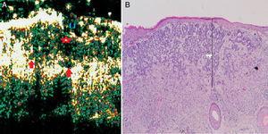 Infiltrative basal cell carcinoma. A, B-mode (20Mhz) cross-section image. Note the heterogeneous subepidermal hypoechoic image (red star) with irregular albeit well-defined borders and numerous hypoechoic extensions into the underlying dermis (red arrows), indicating infiltration. The lesion is also ulcerated, as shown by the interruption in the underlying epidermis (U). B, Histologic image of the tumor (hematoxylin-eosin, original magnification ×4).
