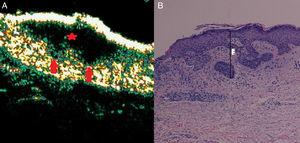 Mixed basal cell carcinoma (superficial and infiltrative). A, B-mode (20Mhz) longitudinal image. Note the anechoic flat heterogeneous subepidermal image with irregular but well-defined borders (red star), in addition to 2 extensions into the underlying dermis on the far right (red arrows), corresponding to foci of infiltration. B, Histologic image of the tumor (hematoxylin-eosin, original magnification ×4).