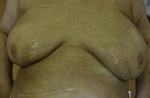 Patches in both breasts and left inframammary fold, showing a shinny white color, liliaceous ring and atrophic surface.