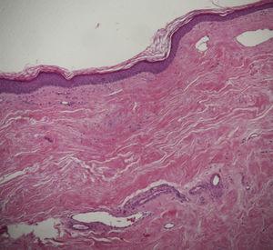 Histopathology (HE ×10): thickened collagen bundles in dermis, closely packed. Epidermal atrophy. Discrete perivascular limphocytic infiltrate.