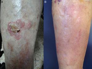 A, Bowen disease lesion on the anterior surface of the right leg of a 90-year-old woman with systemic lymphoma being treated with chemotherapy. B, Complete clearance of lesion after 3 cycles of photodynamic therapy with methyl aminolevulinate. No recurrences were detected during follow-up.