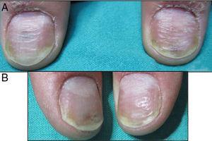 (A) Matrix and bed nail psoriasis before treatment. (B) After four sessions of PDL (right thumbnail) and four sessions of Nd:YAG (left thumbnail).