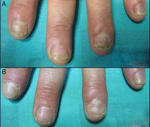 (A) Distal onycholisis, subungueal hyperkeratosis and distal oil drop of nail plate psoriasis of the left hand before the treatment. (B) After four sessions of Nd:YAG.