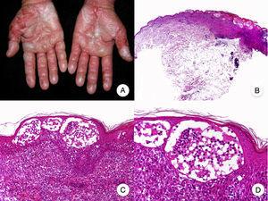Bullous mycosis fungoides. A, Photograph showing symmetric vesicular bullous lesions on the hands. B, Panoramic view showing intraepidermal bullae. C,D, Detailed view of the bullae, with atypical lymphocytes in the papillary dermis and epidermotropism.