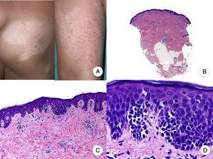 Hypopigmented mycosis fungoides. A, Photographs showing hypopigmented macules and plaques without cutaneous atrophy in a child. B, Panoramic view showing an infiltrate in the superficial dermis. C,D, Detailed view of the dermal infiltrate with atypical lymphocytes and epidermotropism.