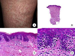 Papular mycosis fungoides. A, Photograph showing small non-folliculocentric papules on a leg. B, Panoramic view showing a mild infiltrate in the papillary dermis. C,D, Detailed view of the dermal infiltrate with atypical lymphocytes and epidermotropism.
