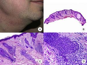 Folliculotropic mycosis fungoides (MF). A, Photograph showing follicular papules and acneiform lesions on the face and neck. B, Panoramic view showing an infiltrate around the hair follicles. C, D, Higher-magnification view showing aggregates of atypical lymphocytes in the outer root sheath of the hair follicle.