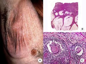 Granulomatous slack skin. A, Photograph showing an erythematous plaque in the form of a large pendulous skinfold in the axilla. B, Panoramic view showing a diffuse inflammatory infiltrate throughout the dermis and extending into the subcutaneous tissue. C, Higher-magnification view showing that the infiltrate is composed of histiocytes, atypical lymphocytes, and giant multinucleated cells with many nuclei.