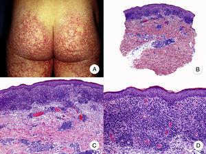 Poikilodermal mycosis fungoides. A, Photograph showing plaques with atrophy, hyperpigmentation, hypopigmentation, and telangiectasia on both buttocks. B, Panoramic view showing a lichenoid infiltrate in the papillary dermis. C, D, Higher-magnification view showing epidermal atrophy with flattening of the dermal-epidermal junction, an infiltrate composed of atypical lymphocytes with epidermotropism and dilatations, and dilated capillaries in the superficial dermis.