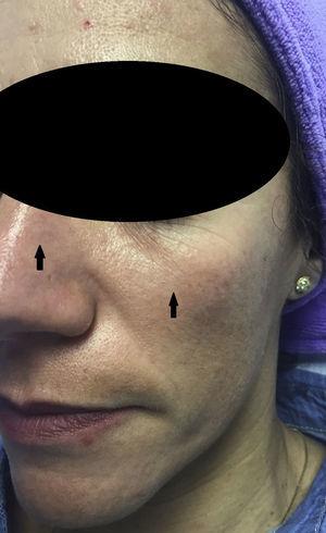 Glycolic acid peel. Erythema prior to neutralization with aqueous bicarbonate solution for the patient's insupportable feeling of pruritus. Erythema, indicated by the arrows, was mild in this case.