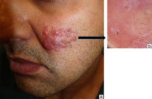 A, Inflammatory plaque formed by multiple coalescing, yellowish, erythematous papules and nodules on the left cheek. B, Homogeneous yellow-orange color with telangiectatic vessels.