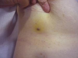 Reddish-violaceous papule measuring less than 1cm surrounded by a yellowish area of skin.