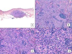 Angiosarcoma with a predominant solid pattern. A, The panoramic image show invasion of the mid and deep reticular dermis and the hypodermis (hematoxylin-eosin, original magnification ×10). B, Densely cellular tumor that has destroyed pre-existing structures and is accompanied by nodular lymphoid infiltrates (hematoxylin-eosin, original magnification ×100). C and D, Detailed view showing a predominance of epithelioid cells accompanied by a lymphocytic infiltrate (hematoxylin-eosin ×200 and ×400, respectively).