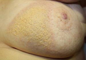 Yellowish plaque with a verrucous, papilliform surface surrounded by an erythematous halo on the left breast.