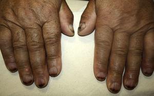 Horizontal melanonychia involving the distal portion of fingernails.
