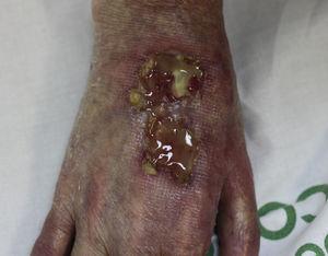 Clean ulcer with a blood-stained base. The lesion measured 6×3cm and had been present on the dorsum of the right hand for 9 months.