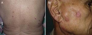 A, Excoriated papules on back. B, Erythematous papules in a linear pattern.