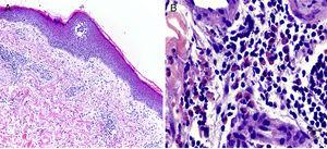 A, Hematoxylin-eosin(×50). Epidermis with mild spongiosis. Mixed inflammatory infiltrate, predominantly perivascular and periadnexal, in the superficial dermis. B, Hematoxylin-eosin (×400). Eosinophil-rich inflammatory infiltrate in the deep dermis.