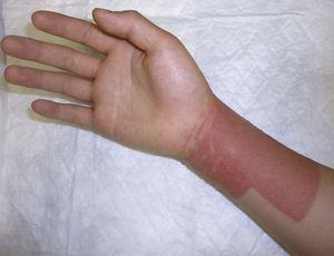 Allergic contact dermatitis caused by colophony and fragrances after application of a dressing.