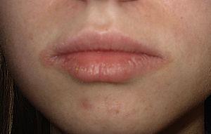 Allergic contact dermatitis caused by fragrances manifesting as cheilitis after application of lipstick.