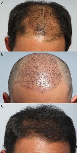Good candidate patient for either follicular unit extraction (FUE) or the strip technique. This patient received 2000 transplanted follicular units using the FUE method with the sharp 0.95-mm Cole punch in the Vortex system (Cole Instruments, Georgia, US). A, Before transplant. B, Twenty-four hours after follicular unit extraction. C, Result a year after the intervention.