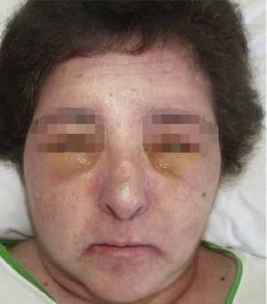 Erythematous-violaceous rash affecting the face and neck. The rash is symmetrical and particularly noticeable on the eyelids.