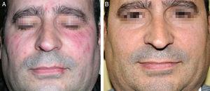 A, Clinical appearance of the lesions before treatment with a single dose of oral ivermectin (250μg/kg). B, Clinical appearance 6 months later.