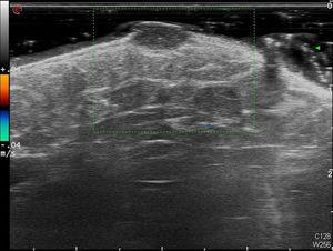 High-frequency (18MHz) Doppler ultrasound image showing a well-defined, homogeneous, hypoechoic lesion measuring 6.5×3.5mm in the dermis, with no blood flow internally.