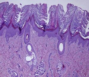 A skin biopsy from an armpit revealed hyperkeratosis, psoriasiform epidermal hyperplasia and slightly thickened granular layer in epidermis, and mild perivascular inflammatory infiltrate of mononuclear cells in papillary dermis (H&E 4×).