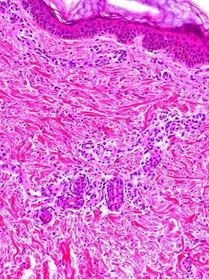 NOMID (neonatal-onset multisystem inflammatory disease). Mixed perivascular superficial and deep inflammatory infiltrate associated with a neutrophilic infiltrate in the eccrine gland (hematoxylin-eosin, original magnification ×20).