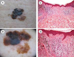 Image showing regression in melanoma. A, Clinical image showing a central region with loss of pigment. B, Dermoscopic features of the lesion showing a multicomponent pattern with a central white area. C and D, Histologic images showing a dense lymphocytic infiltrate in the dermis without epidermal involvement, together with melanophages and fibrosis in the dermis (hematoxylin-eosin, original magnification ×10 [C] and ×20 [D]).