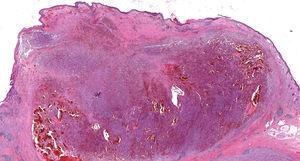 Hematoxylin-eosin.