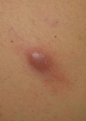 Erythematous-violaceous subcutaneous nodule of 2×1.5cm in the right scapular region.