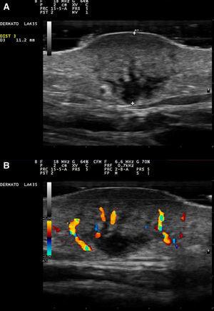 A, B-mode ultrasound, 18MHz. Dermal nodule with extension into the subcutaneous cellular tissue, with a heterogeneous content and poorly defined borders. Lower echogenicity of the superficial and deep planes compared with the intermediate plane. B, Color Doppler ultrasound showing large-caliber vessels within the tumor.