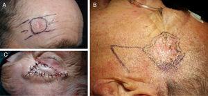 A, The flag flap was chosen as the flap of choice for the forehead. B, The Limberg flap was the flap of choice for the lateral forehead. C, The subcutaneous island pedicle flap was the flap of choice for the brow. Photographs courtesy of Dr. Donis Muñoz Borras.