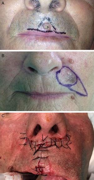 A, A-T flap for the philtrum of the lip. B, Subcutaneous island pedicle flap for the upper lip. C, The bilateral perialar horizontal advancement flap for the vermilion of the upper lip. Photograph A courtesy of Dr. Soledad Saénz Guirado. Photograph B courtesy of Dr. Antonio Clemente Ruiz de Almirón. Photograph C courtesy of Dr. Francisco Vilchez.