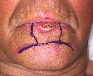 The double labiomental advancement flap for the vermilion of the lower lip. Photograph courtesy of Dr. Dolores Sánchez Aguilar.