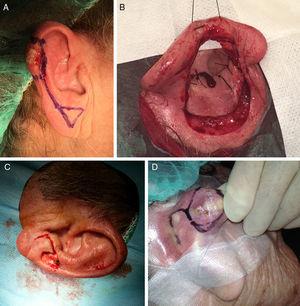 A, The helical advancement flap was the flap of choice for the helix of the ear. B, The revolving-door flap for defects of the concha of the ear. C, The Limberg flap for the earlobe. D, The Limberg flap for retroauricular defects. Photograph A courtesy of Dr. Alfonso Rodríguez Bujaldón.