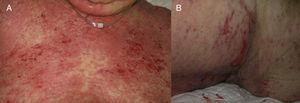 A, Onset of the lesions as large desquamating erythematous plaques. B, Subsequent formation of erosions.