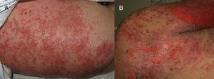 A, Formation of tense blisters on the thigh. B, Final stage of widespread epidermal detachment.