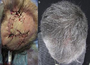 A, Immediate postoperative result. B, Final outcome 2 months after the operation.