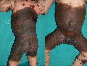 Giant (or garment) congenital melanocytic nevus extending to the trunk, buttocks, and proximal upper legs.