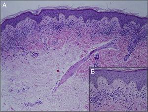 Histologi av lesjonen. A, et bandlignende lichenoid inflammatorisk infiltrat i papillær dermis, som ikke påvirker hudens vedlegg. Hematoksylin og eosin (HE), original forstørrelse×10. B, Utbredt ekstravasasjon av røde blodlegemer. SE, original forstørrelse×40.