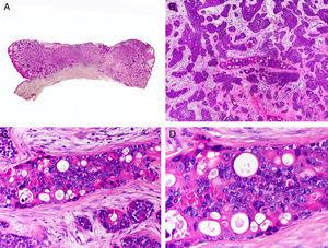 Histopathologic characteristics of porocarcinoma. A, Panoramic view showing an ulcerated tumor invading the full depth of the dermis. B, Neoplastic aggregates of varying shapes and sizes. C, Signs of ductal differentiation in some of the neoplastic aggregates. D, Detail of small ducts lined by cuticular cells. (Hematoxylin-eosin, original magnification ×10 [A], ×40 [B], ×200 [C], ×400 [D]).