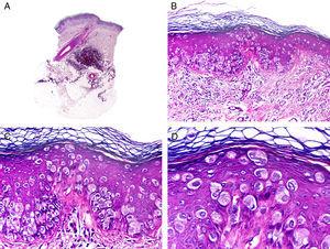 Histopathologic characteristics of extramammary Paget disease. A, Panoramic view showing an intraepidermal lesion. B, The tumor is formed by isolated neoplastic cells scattered through the dermis. C, Note the pleomorphic nucleus and abundant pale cytoplasm in the neoplastic cells. D, Detail of neoplastic cells scattered through the epidermis. (Hematoxylin-eosin, original magnification ×10 [A], ×40 [B], ×200 [C], ×400 [D]).